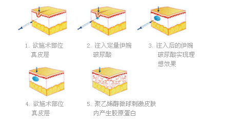 伊婉玻尿酸作用原理,苏州美贝尔整形美容医院